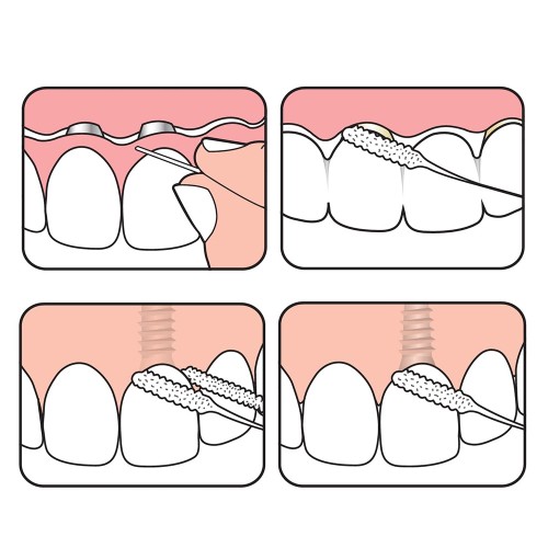 TePe Bridge & Implant Floss Σπογγώδες Νήμα Καθαρισμού Γεφυρών & Εμφυτευμάτων 30τμχ