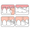 TePe Bridge & Implant Floss Σπογγώδες Νήμα Καθαρισμού Γεφυρών & Εμφυτευμάτων 30τμχ