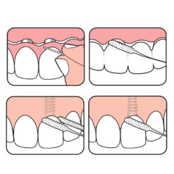 TePe Bridge & Implant Floss Σπογγώδες Νήμα Καθαρισμού Γεφυρών & Εμφυτευμάτων 30τμχ